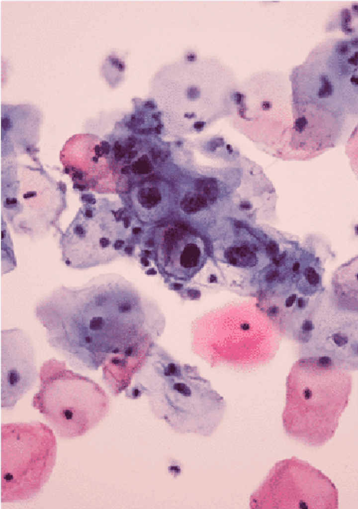 Pink and purple cells are shown infected with HPV, showing up as black dots.